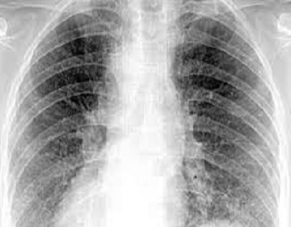 xray